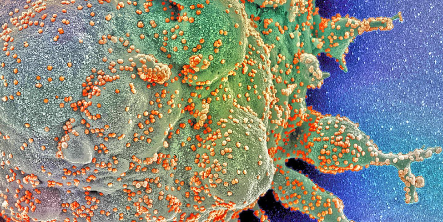 Imagem microscópica de uma célula humana sendo atacada por coronavírus.